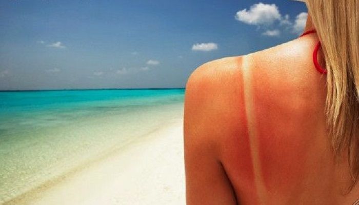 7 consejos para combatir las Quemaduras Solares