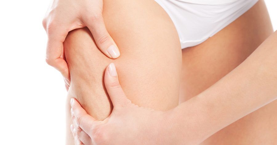 Cómo eliminar la Celulitis - Todo lo que tienes que saber