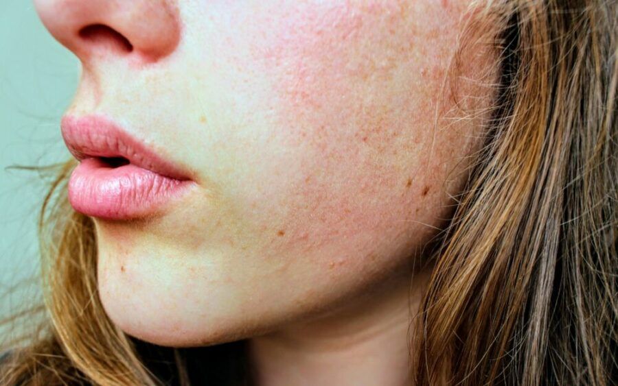 La piel seca, también llamada piel alípica se caracteriza por